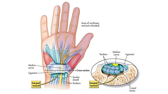 Do You Have Carpal Tunnel Syndrome?